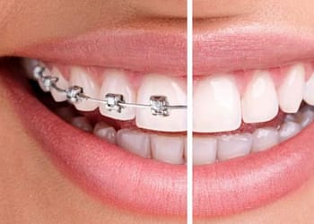 consejos antes de ponerse brackets