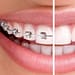consejos antes de ponerse brackets