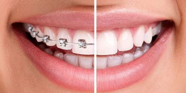 consejos antes de ponerse brackets