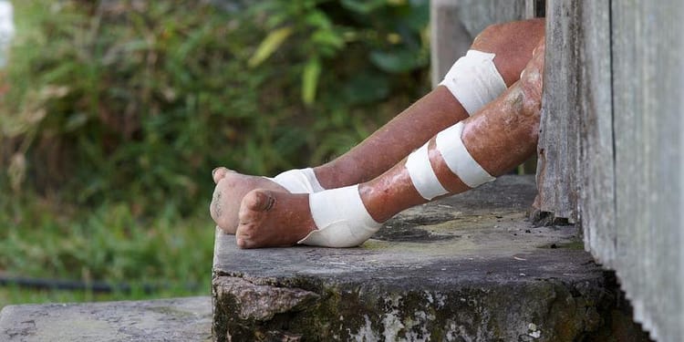 Secretaría de Salud alerta por 12 municipios con casos de lepra en México. | Foto: Getty images.